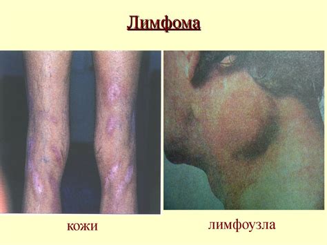 Лимфоциты, как ключевые клетки адаптивного иммунитета - online presentation