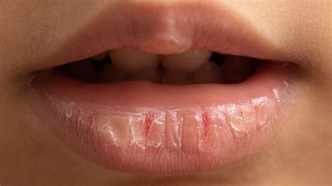 Labios Seca O Que Pode Ser