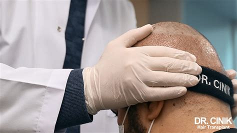 Post-Hair Transplant Infections: Symptoms, Risks, and Treatment