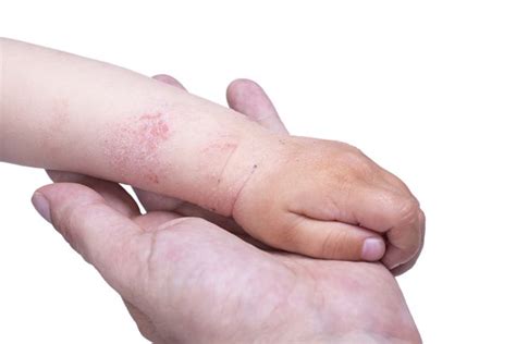 Mupirocin - Manfaat, Dosis, dan Efek Samping - Alodokter