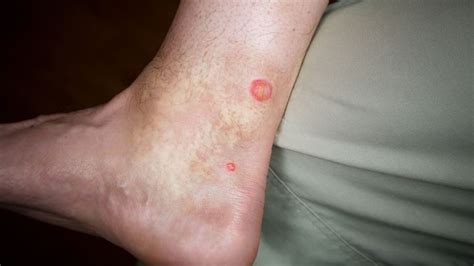 Deer Fly Bites On Humans