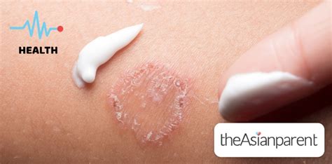 how to cure ringworm at home fast