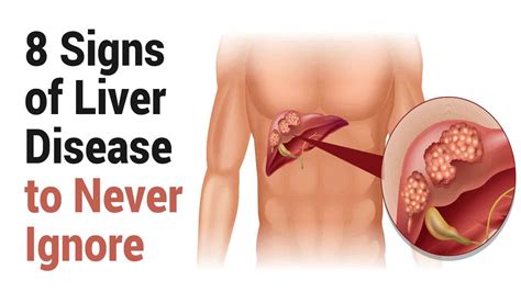 8 Signs of Liver Disease to Never Ignore | Power of Positivity