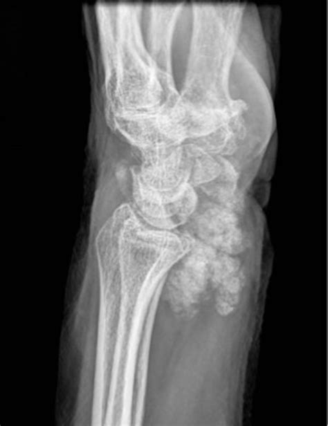 Case of tumoral calcinosis on images: a rare clinicopathological entity
