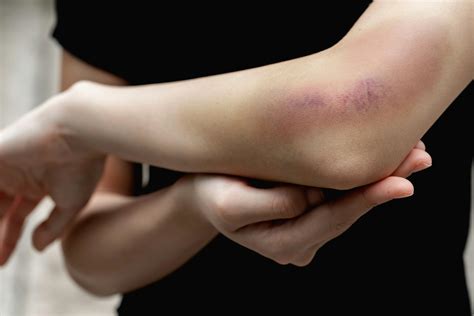 concealer  bruises cheaper  retail price buy clothing
