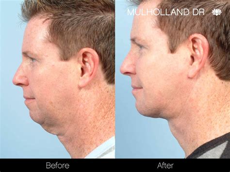 Under Chin Surgery
