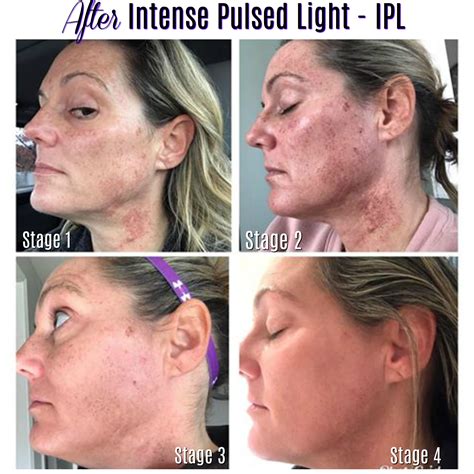 The IPL Journey – How To Remove Sun Spots and Redness – Charmed Medispa