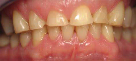 Before and After Photos - Dentist in Chelmsford | Future of Dentistry