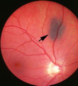 picture  choroidal nevus    paler color