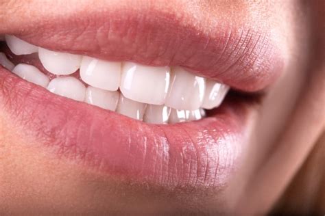 Four Tips for Preparing for a Dental Veneers Procedure - My Saratoga ...