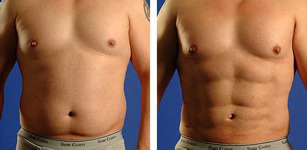 Sve vrste liposukcija | | estetica.hr