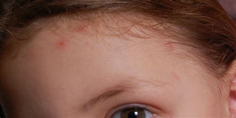 Pourquoi il faut vacciner ses enfants contre la varicelle