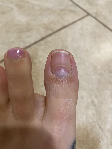 Fungus or Onychomadesis : r/NailFungus