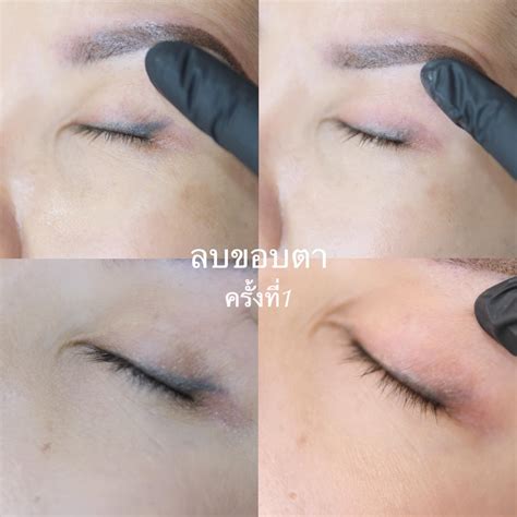 punwarin laser