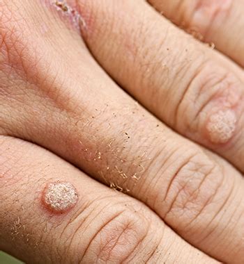 Types Of Warts And How They're Treated: Clement Banda, MD:, 47% OFF