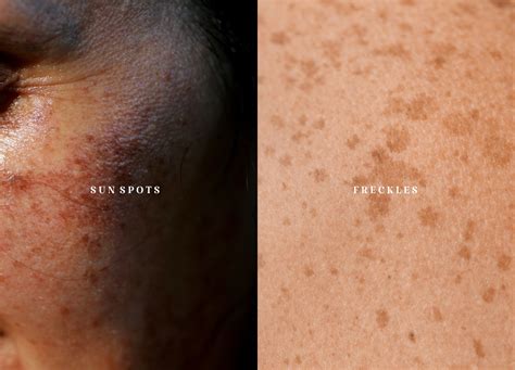 Pico Laser: Is It Right for Sun Spots or Freckles?