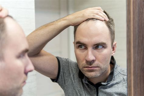 receding hairline  caused    fix  aventus clinic