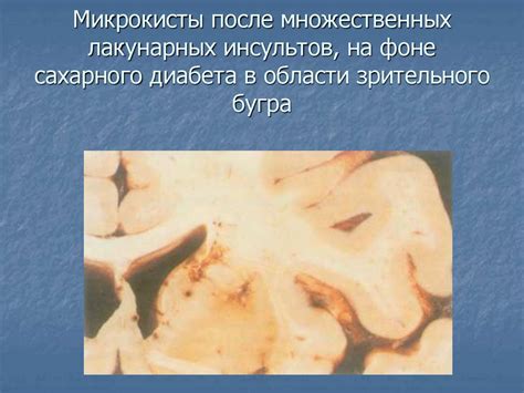 Диабетическая энцефалопатия - презентация онлайн