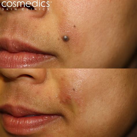 Shave Excision Mole Removal | Cosmedics Skin Clinics
