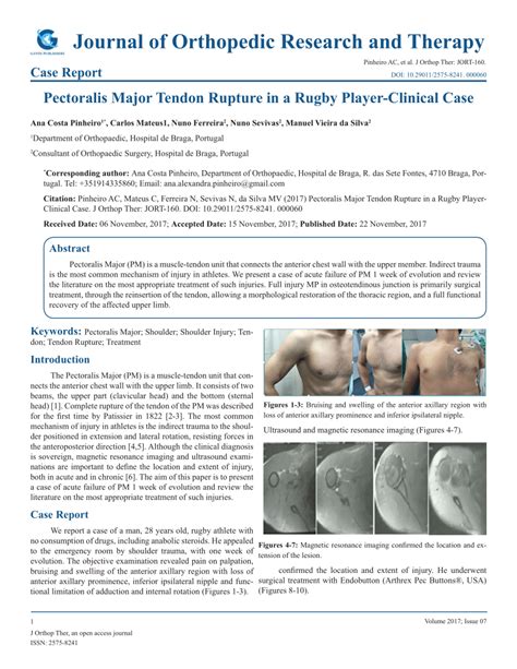 Full article: Pectoralis Major Tendon Rupture in a Rugby Player ...