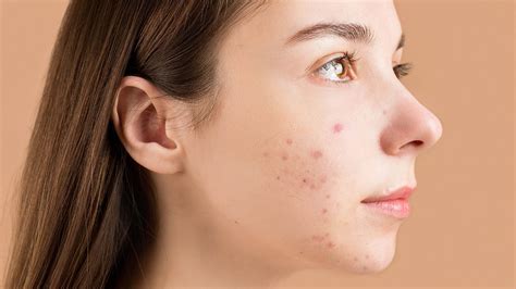 Nodular Acne: Causes, Treatment, Home Remedies And Prevention - Zwivel