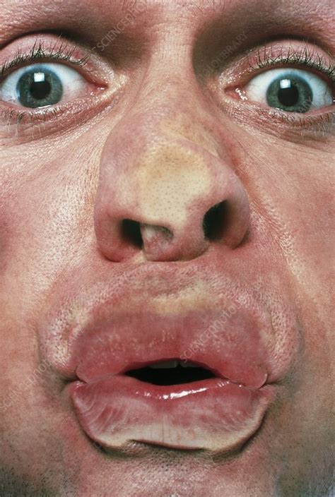 squashed face   man stock image  science photo library