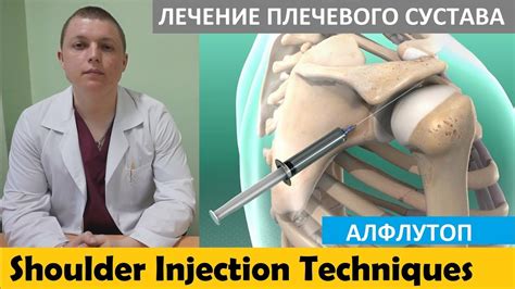 Локальная инъекция | Лечение боли в плече | АЛФЛУТОП | Subacromial ...