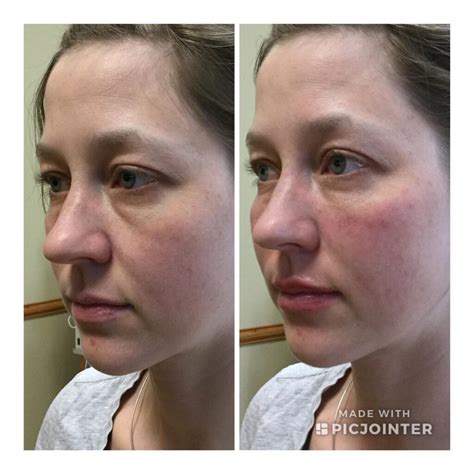 Sunken Eyes (Enophthalmos) Causes, Treatment, Remedies & FAQ