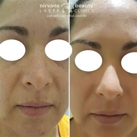 DERMAPEN BEFORE & AFTERS - Nirvana Beauty Laser Clinics