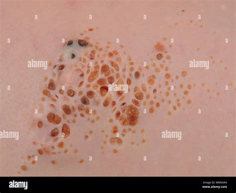 CUTANEOUS HAMARTOMA Stock Photo - Alamy