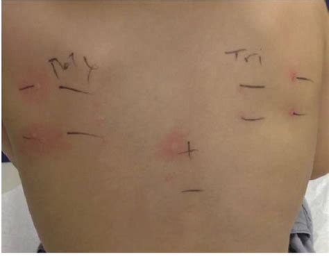 Figure 1 from Anaphylaxis to polymyxin B-trimethoprim eye drops ...