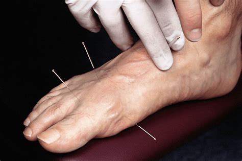 What to Expect After Acupuncture - Footwise Podiatry Ltd– Galway Nail Surgery Specialists