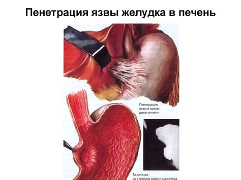 Язвенная болезнь желудка и двенадцатиперстной кишки - презентация онлайн