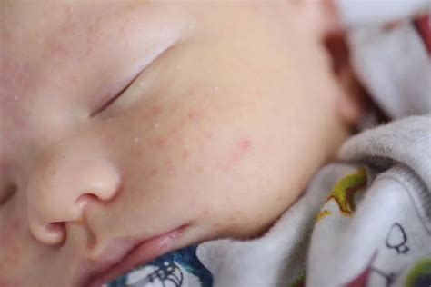 Espinha Em Bebe De 2 Anos