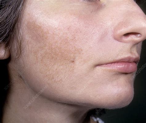 Melasma (chloasma) on the face - Stock Image - C013/1061 - Science ...