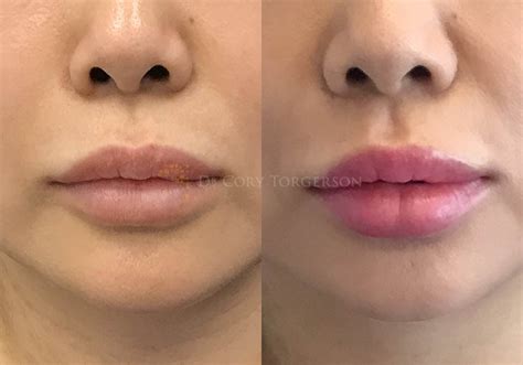 Lip Flip Botox Before And After Photos - Infoupdate.org