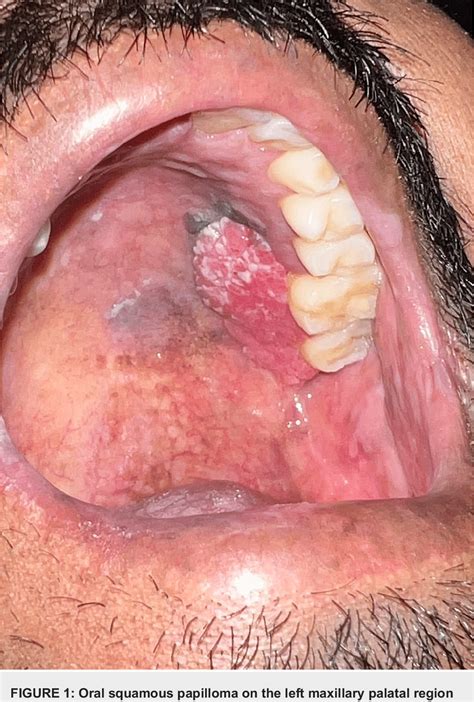 The Hidden Dangers Of Squamous Papilloma 6006614 What You Need To Know