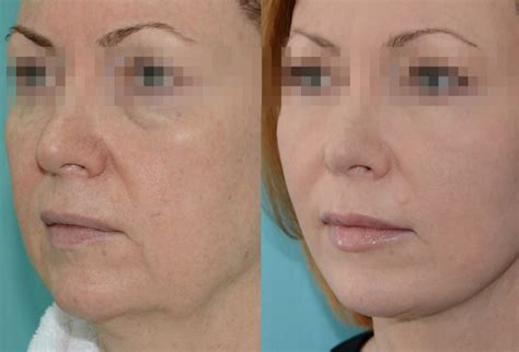 Круговая подтяжка лица - виды, обзор операции, отзывы + фото до и после