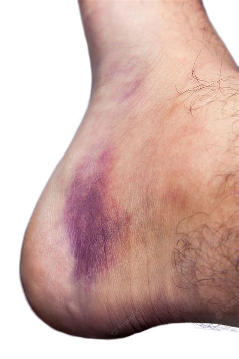 bruised ankles - Clip Art Library