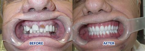 Before and After - Snap in Dentures | Snapindentures