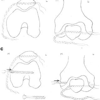 e Anatomy of normal medial patellofemoral ligament. | Download ...