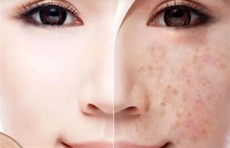 phuong phap tri nam da tai nha