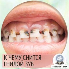 Сонник: гнилой зуб