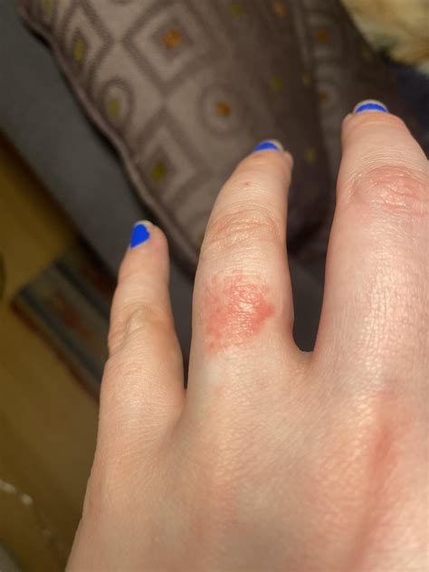 is this ring rash? : r/DermatologyQuestions