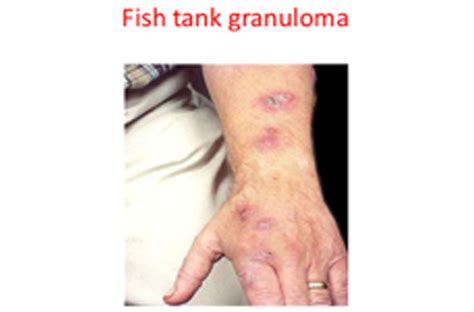 Fish Tank Granuloma