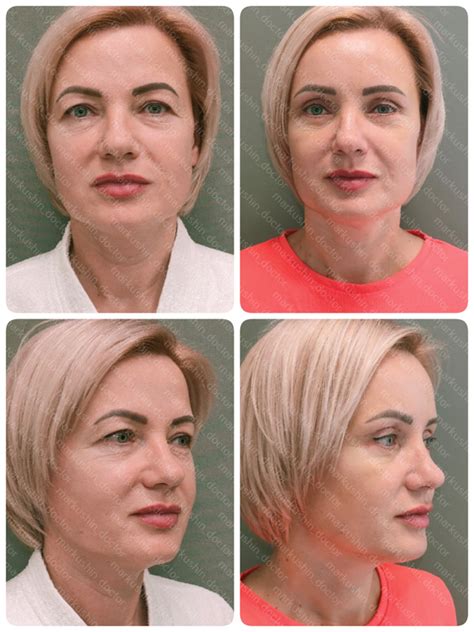 Эндоскопическая подтяжка лба и висков в сочетании с круговой ...