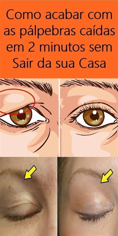 Pálpebras Ressecadas E Descamando