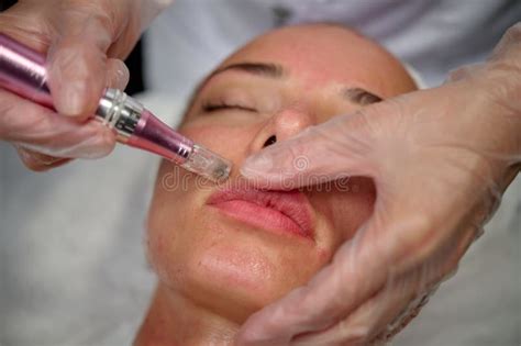 Anti-aging Care with Dermapen, Patient Face Close-up Stock Image ...