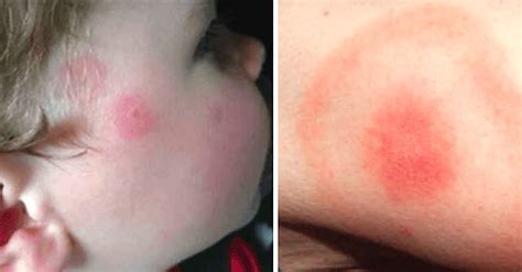 sons lyme disease   mistaken   simple rash