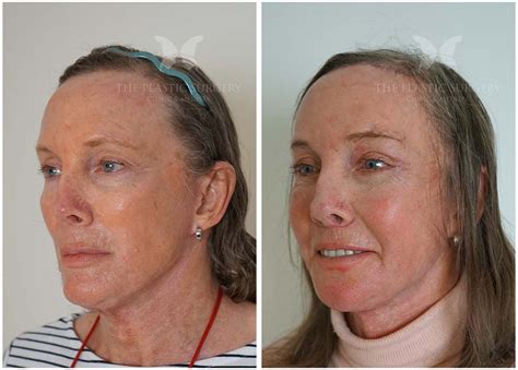 Facial Fat Grafting Gallery | The Plastic Surgery Clinic